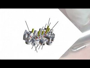 Stackable Guides to reduce Surgery Time
