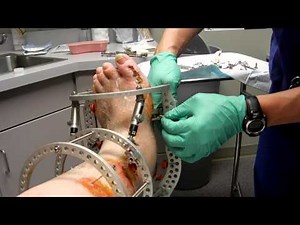 Ross' external fixator removal