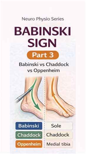 Khushi Agrawal on Instagram: "Different methods. Same response. Upper motor neuron lesion. #babinskisign #chaddocksign #oppenheimsign #umnlesion #neurophysio"