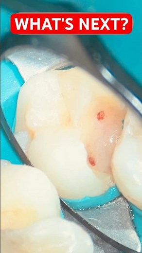 Can This Tooth Stay Vital? 🦷 | Deep Caries Excavation