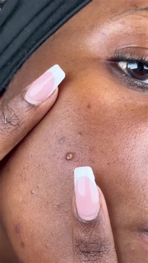 How to remove dark spots and acne #skincare