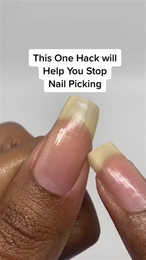 Effective Nail Picking Treatment: Stop Picking Your Nails Today!