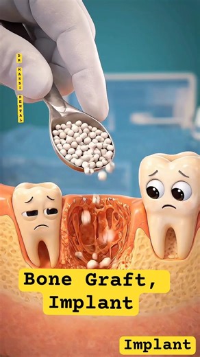 AI video, Bone Graft , Dental Implants