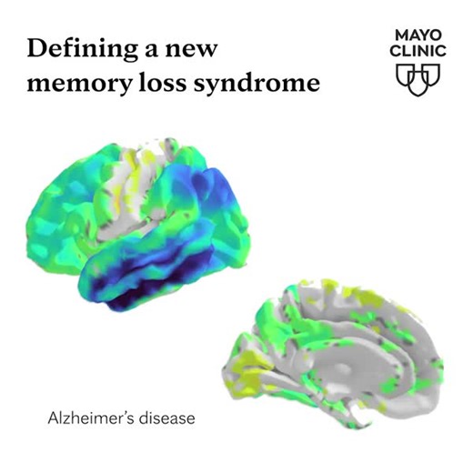 Researchers at Mayo Clinic have published new criteria for a memory-loss syndrome in older adults caused by changes to the brain’s limbic system. It is often mistaken for Alzheimer's disease. The good news: Limbic-predominant Amnestic Neurodegenerative Syndrome, or LANS, progresses more slowly and has a better prognosis. ⁠ ⁠ Learn more: https://mayocl.in/4cIBdtj | Mayo Clinic