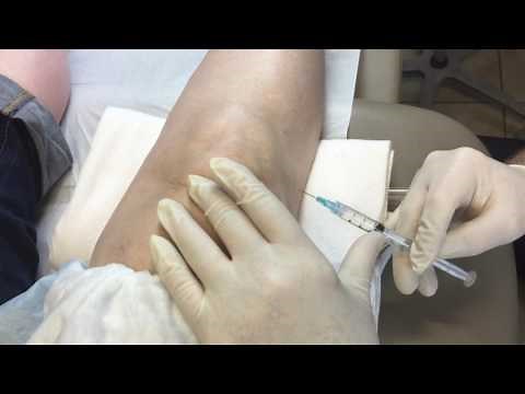 Lateral Retropatellar Injection of Euflexxa