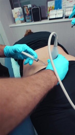 How to relieve back pain? Steroid injections for back pain aren’t meant to “fix” your spine forever. They’re designed to calm inflammation, reduce pain, and give you a window to move again. When pain goes down, staying active becomes possible. That’s when physical therapy, strengthening, and better movement patterns actually lead to long-term recovery. The injection helps break the pain cycle. What you do after is what makes the difference. #painmanagement #painrelief #backpain #recovery