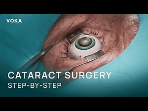 Cataract Surgery Explained in 3D: Phacoemulsification Step-by-Step