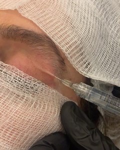 1.9K views · 36 reactions | سوفت فلر للتعبئة جفن العلوي Soft filler for filling upper eyelid @marvin_beauty_center فیلەری نەرم بۆ پركردنی پێلوی سەر چاو | Marvin beauty center | Facebook