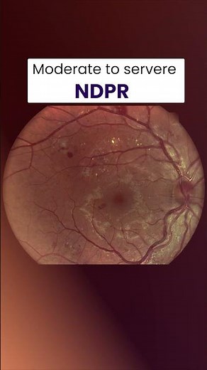 How Diabetes Damages Your Eyes (Stages Explained)
