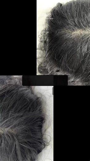 Caress skin clinic on Instagram: "Before & after Exosomes — real results you can see. Stronger roots, improved density, healthier hair growth at Caress. #CaressClinic #HairExosomes #HairRestoration #BeforeAfter #HairRegrowth #AdvancedAesthetics"