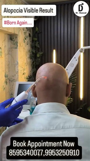 Hair Regrowth in Alopecia Areata | Natural Treatment Results