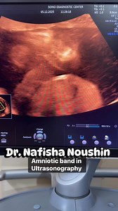 Amniotic band in ultrasonography #drnafisha #pregnancy #ultrasound #amnioticbandsyndrome #AnomalyScan | Dr. Nafisha Noushin