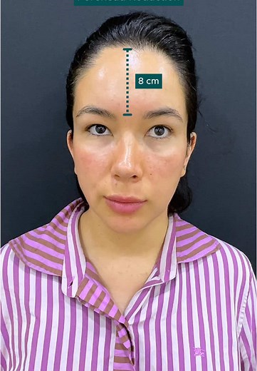FOREHEAD REDUCTION 📐 8 cm to 5 cm Our gorgeous patient came to Istanbul from #Spain 🇪🇸 for #foreheadreduction👳🏻‍♀️ Her forehead length was 8 cm before the surgery and we lowered it to 5 cm to achieve a proportional and elegant apperance 🪄 📌 Forehead reduction surgery is an operation that takes about 2 hours under general anesthesia, you need to stay in hospital overnight and are discharged the next day, our patients can go back to their country on the 4rd day after the operation ✈️ ⏱️Proc