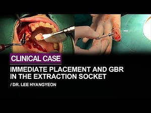 Immediate implant placement and GBR in the extraction socket