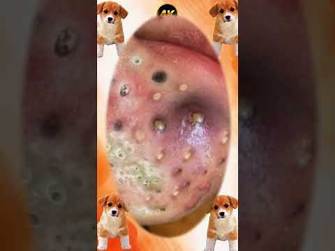 Blackheads Removal #620 | Acne Treatment and Very Satisfying Satisfying Pimple pop #blackheads