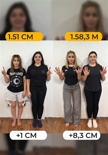 Leg Lengthening Journey: 8.3 cm Transformation Results