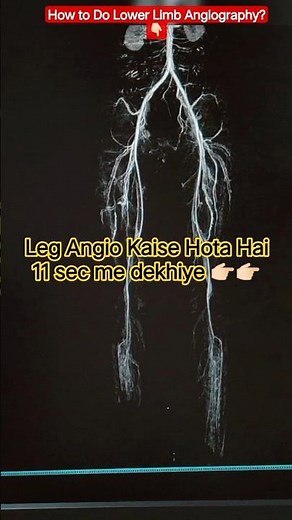 How to Do 🦵🏻Lower Limb Angiography?#tech #radiographer #ctscan #medical