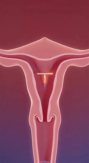 How the Copper IUD Works Inside the Body _