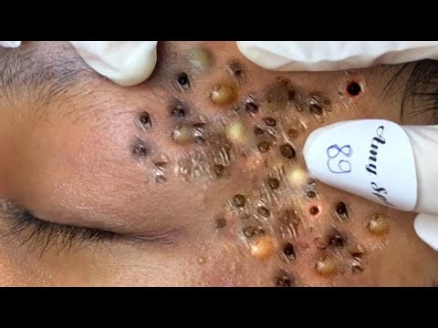 This Pimple Explosion Is So Satisfying! (Relax Every Day SacDepSpa) #26