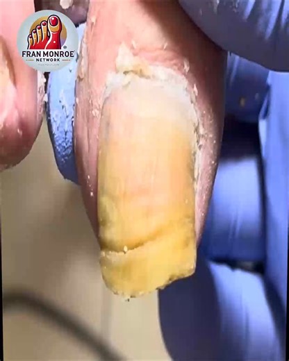 11K views · 83 reactions | U.S. Foot Doctors Recommend Healthy Aging Feet Without Risky Tools #diabeticsupport #agingwell #noninvasive | Fran Monroe | Facebook