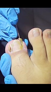 9.2K views · 38 reactions | #toenails #toes #feet #pedicure #reels #toes #feet #pedicure #nails #prettytoes #footfetish #footcare #barefeet #podiatrist #feetstagram #toe #reelsviral #reelsviralfb #viralpost | Emaly | Facebook