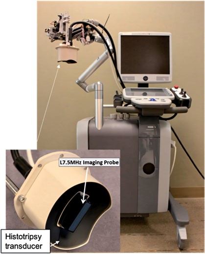 Histotripsy: How sound waves could impact tumor treatment