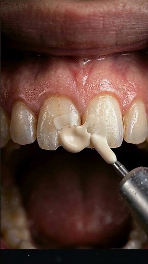 Chipped Tooth Repair in 60 Seconds 🦷✨ (Broken Tooth Fix)