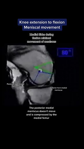 How does the normal knee move? 🦵🏽The normal medial femur is stable in the AP plane from 0-120 degrees the medial femoral condyle acts as a an axis of rotation of the knee joint 🦵🏽The medial femur 'rocks at 20 degrees but does not roll back 🦵🏽The lateral femoral condyle rolls and slides backwards and forwards - approximately 19 mm from 5-120 degrees 🦵🏽No deep squats or sitting cross-legged for 4/12 after posterior horn meniscal repairs‼️ #kneesurgery #kneesurgeryrecovery #kneepain #menisc