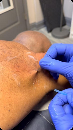 🏆 Dry needling stimulates a local twitch response—an involuntary contraction that helps release tight muscle fibers and restore normal tone. It also increases blood flow and decreases chemical irritation in the tissue. 🏋🏾‍♂️🏃🏼‍♀️🏌🏽‍♂️ #DryNeedling #TriggerPointTherapy #ChicagoChiropractor | Dr_kyleross