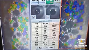 جهاز المجهر البراق .le microscope spéculaire جد هام قبل عمليات التصحيح والماء الأبيض . . . #لترى_الحياة_أفضل #كامش #تصحيح_النظر #ماء_ابيض #قرنية_مخروطية #العدسات_الطبية #جفاف_العين #قصر_النظر #التهاب_العيون #جراحة_العيون #طب_العيون #ليزر #ليزك . . . #vision #cataracte #keratocone #medical_lentilles #eye_pressure #dry_eye #eye_inflammation #eyenail #oeil_sec #eye_surgery #ophtalmologie #crosslinking #lasik #laser #ICL #evo_visian_ic #uveite --------------------------------------------------------