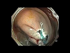 Colonoscopy: Cecum - LST-NG - EMR • Video • MEDtube.net