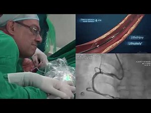 Transradial Intra-Vascular Lithotripsy (Shockwave IVL) at CIMS Hospital