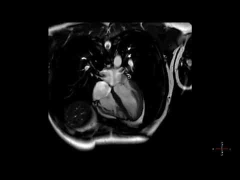 Heart beating on a cardiac MRI scan in high resolution - ECG gated CMRI in HD - real time scan