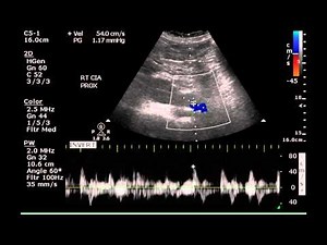 Duplex Examination of an Aortic Aneurysm - Case Study