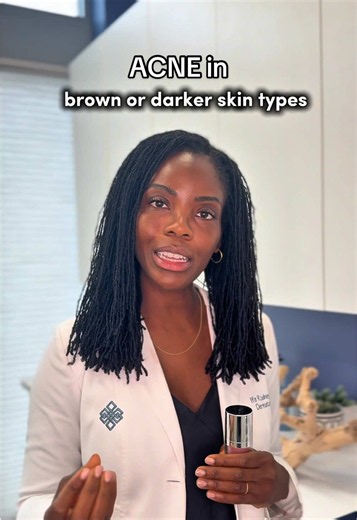 Understanding Post-Inflammatory Hyperpigmentation and Acne