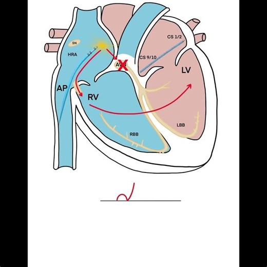 Decremental Atrial Pacing – Diagnosing Preexcitation Mechanisms #ecg