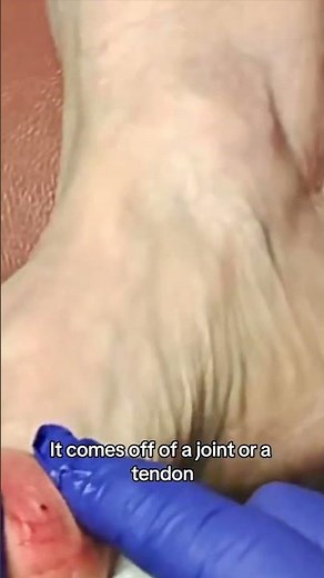 Ganglion Cysts Are NOT Nerves! 🤯