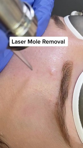 Do you have these? #mole #moleremoval #laser #skintok #skinbydrazi | mole