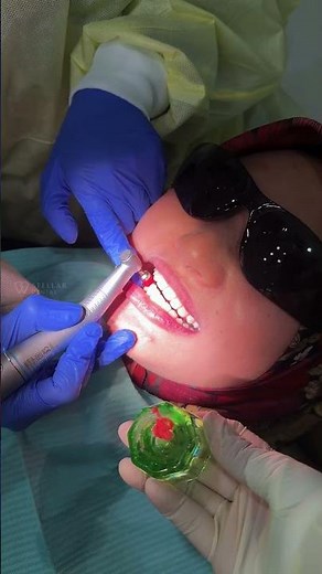 Braces Transformation Before & After