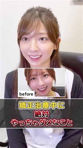 矯正治療中にやると上手く進まなく可能性があるからやらないようにして…！！ #歯科衛生士 #歯列矯正 #矯正 #矯正女子 #マウスピース矯正