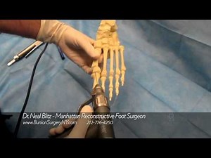 Bunion Surgery Video Saw Bones Dr Blitz