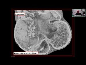 Anatomy Session #6: Functionally Univentricular Heart
