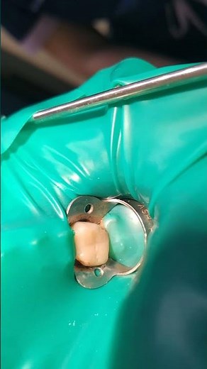 single isolation 26 tooth.#cofferdamrubber #раббердамология