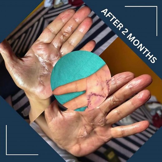 Dupuytren's Contracture