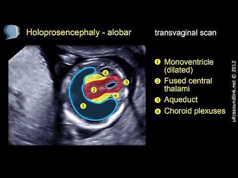 Holoprosencephaly (alobar)