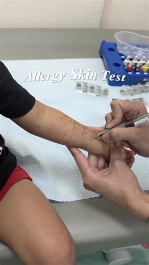 Krei’s Allergy Skin Test: Understanding Food and Environmental Allergies