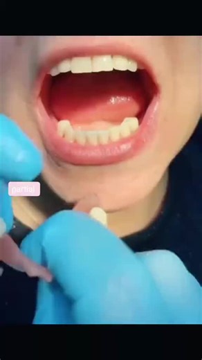 Flexible Dentures: Comfort and Convenience for Your Smile