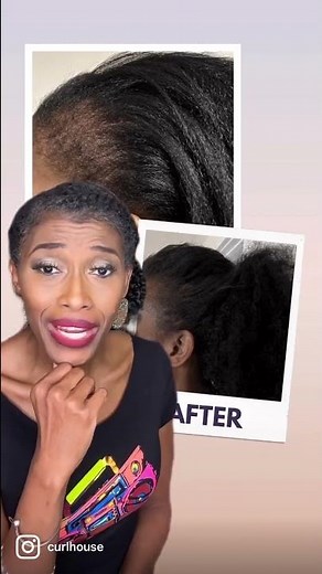 TRACTION ALOPECIA REVERSED!