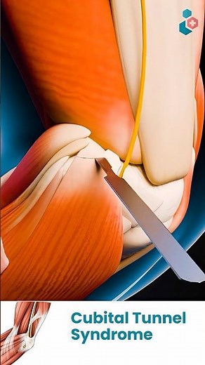 Cubital Tunnel Syndrome | 3D Medical Animations #NerveCompression #CubitalTunnelSyndrome