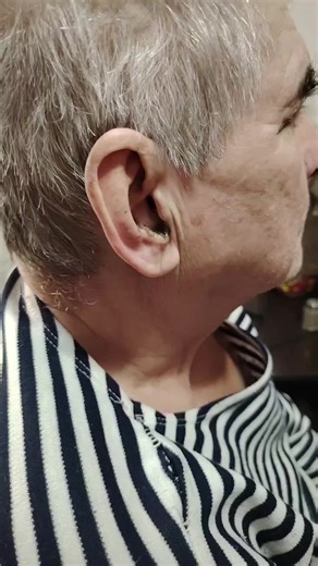 Effective Earwax Removal Techniques You Need to Know